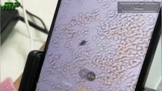 Analyse au microscope optique du sang d'une fillette de 6 ans vaccinée.