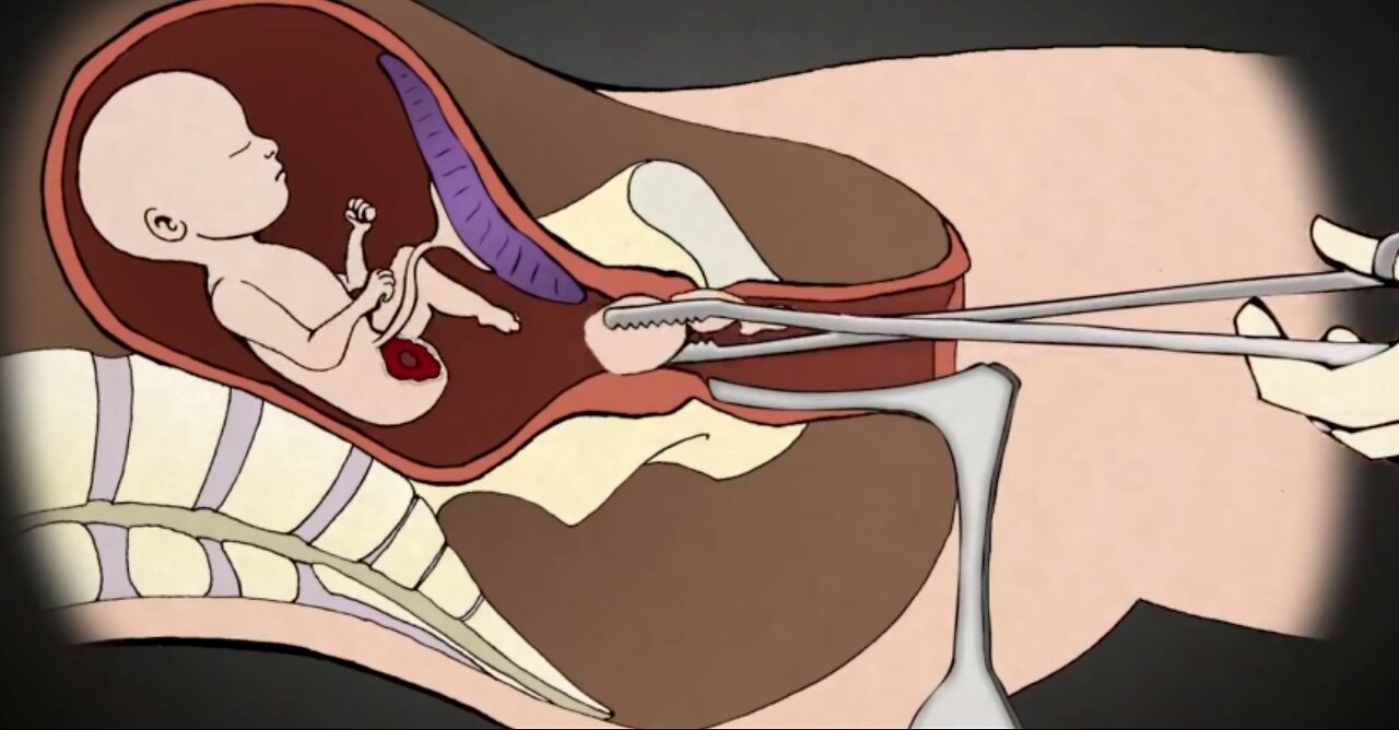 Former Abortionist, Dr. Anthony Levatino Exposes the Barbaric Truth regarding Abortion
