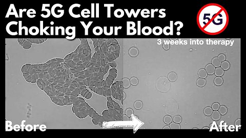 How EMFs Hijack Your Blood—and How to Fight Rouleaux!