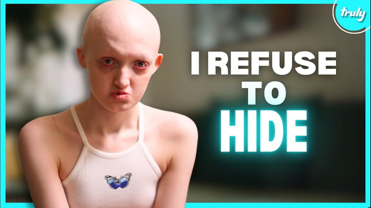 My Rare Condition Took My Hair & Teeth | BORN DIFFERENT