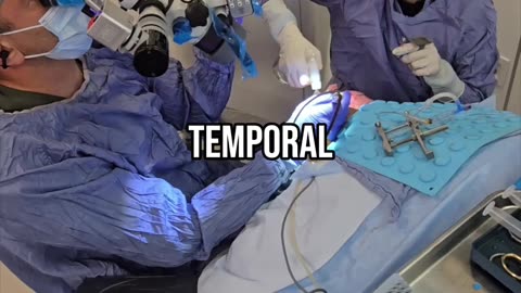 3000 graft FUE + crown with natural density and conservative design.