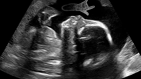 ICSI Treatment at Sumathi Hospital: Pioneering Fertility Care in Madurai