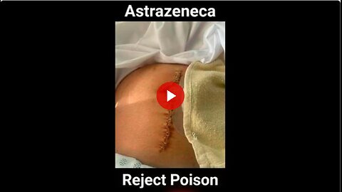 This guys life has been a living hell since he got the jab. Had to have 6ft of intestine removed