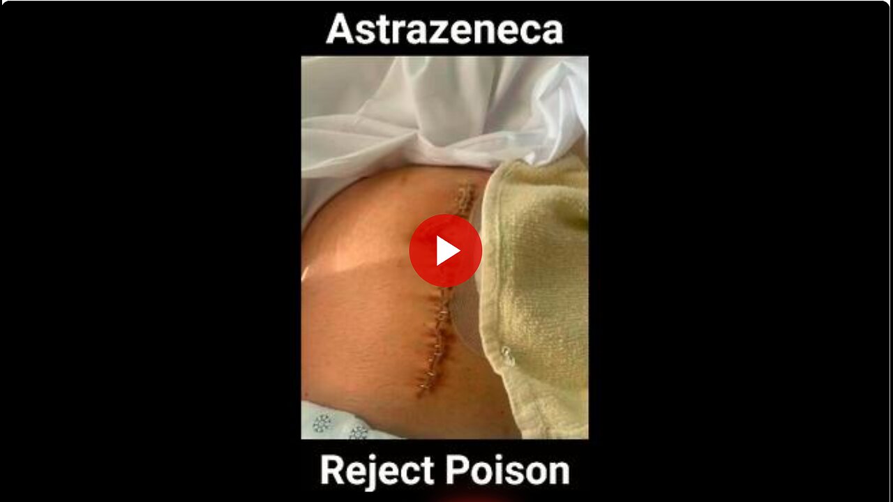 This guys life has been a living hell since he got the jab. Had to have 6ft of intestine removed