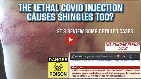 WHAT DID I FIND WHEN SEARCHING VAERS COVID INJECTIONS INVOLVING "SHINGLES?"