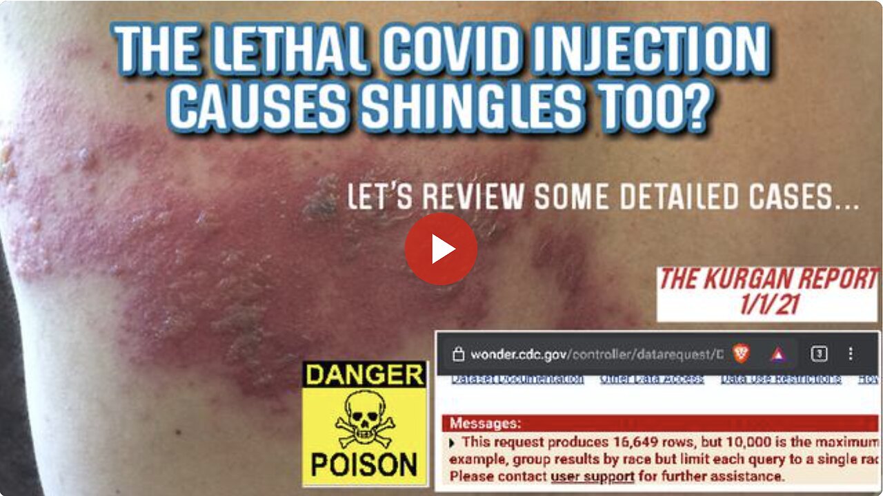 WHAT DID I FIND WHEN SEARCHING VAERS COVID INJECTIONS INVOLVING "SHINGLES?"