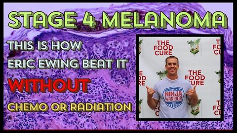 "Stage 4 Melanoma Triumph: Eric Ewing's Chemo-Free & Radiation-Free Fight Against Cancer"