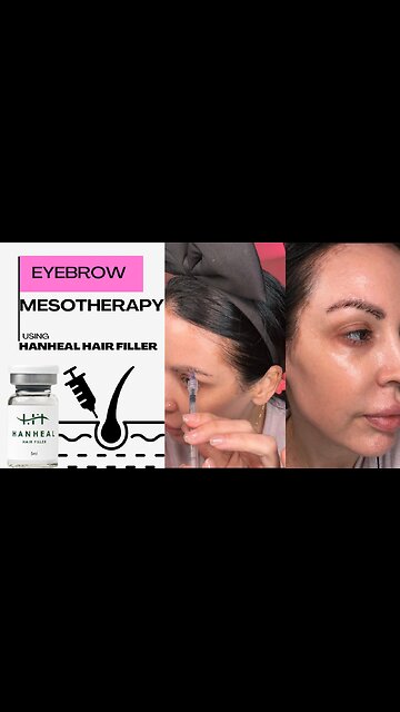 Eyebrow Mesotherapy using HanHeal Hair Filler Acecosm.com code: Jamie10