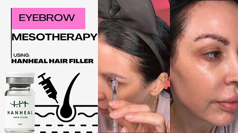 Eyebrow Mesotherapy using HanHeal Hair Filler Acecosm.com code: Jamie10