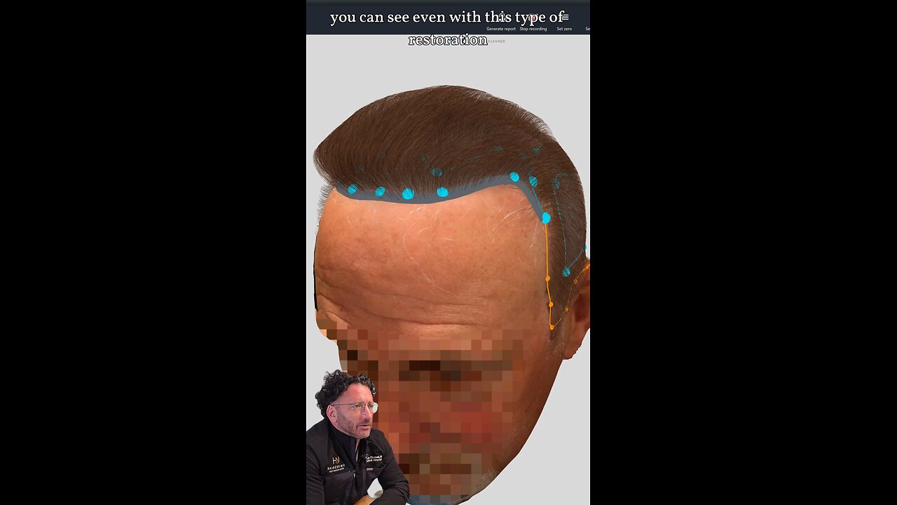 4300 Grafts. One Day. 0 Shortcuts