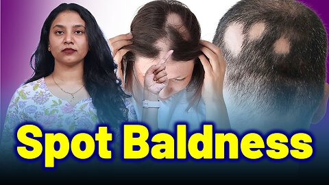 Alopecia Areata, Patchy Hair loss, Spot Baldness.| Treatment Cure Relief Medicine | Skin Hair Nail |