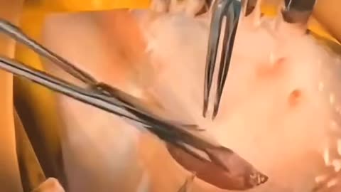 Severe Stomach Pain Here’s How Doctors Remove an Infected Appendix in Minutes!