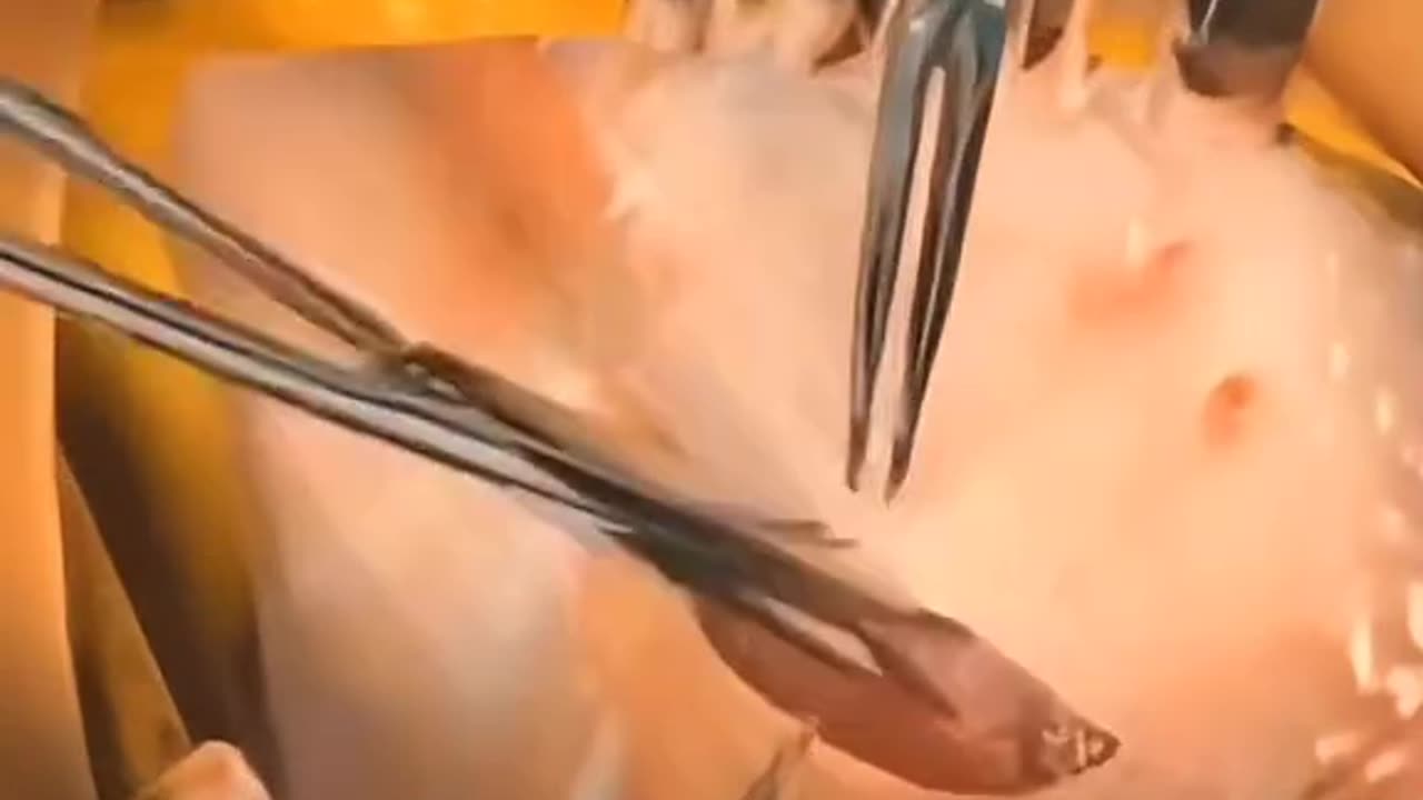 Severe Stomach Pain Here’s How Doctors Remove an Infected Appendix in Minutes!