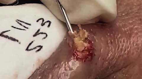 Latest blackhead removal videos (ASMR) #1