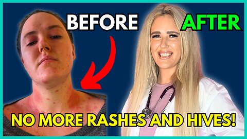 How to HEAL Histamine Intolerance Naturally!