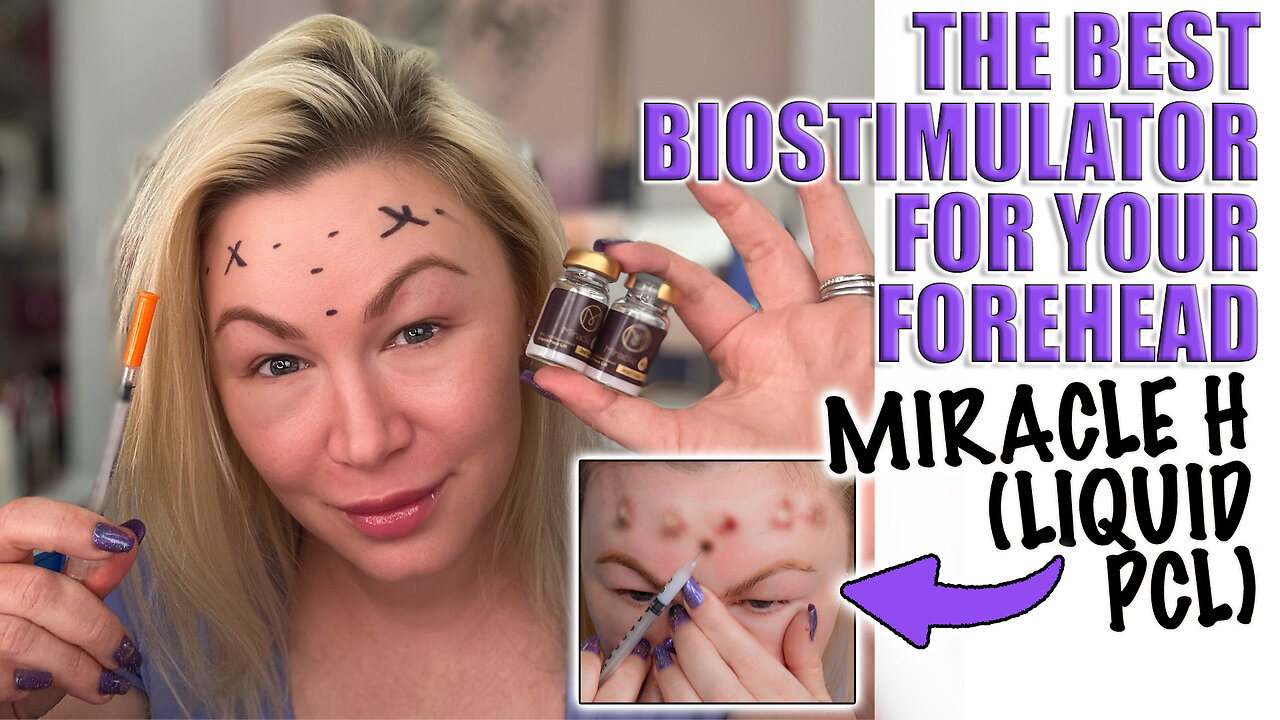 The BEST Biostimulator for Your Forehead, Miracle H (Liquid PCL), ACeCosm.com code Jessica10 saves