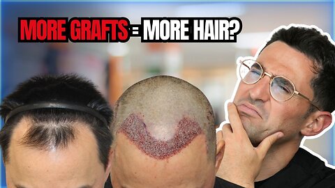 SAFE Hair Graft Extraction Explained! Don’t Overharvest Your Donor Area