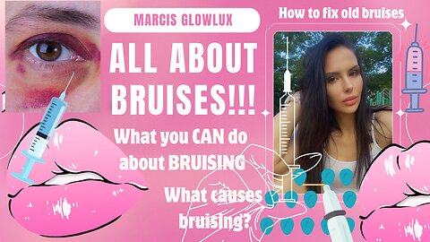 All ABOUT BRUISES how? Why? Now what?