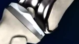 Knee replacement explained simply in less than 1 minute