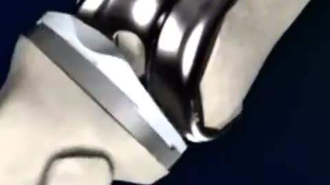 Knee replacement explained simply in less than 1 minute