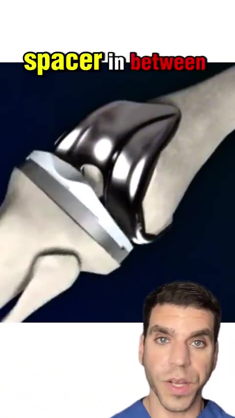 Knee replacement explained simply in less than 1 minute