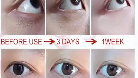 Fat Granules Removal Eye Serum Eye Milia Repair Treatment Products