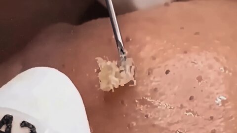 Relaxing soul uplifting blackhead removal video #1