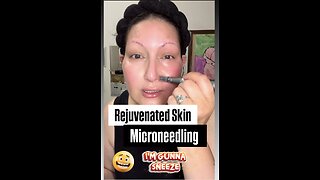 Rejuvenated Skin Microneedling With Exosomes & Stem Cells 💁🏻‍♀️Acecosm - Beautiejunkie10