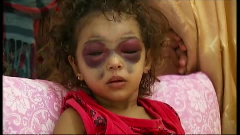 Niema la bambina con gli occhi a "Panda" ritrovata