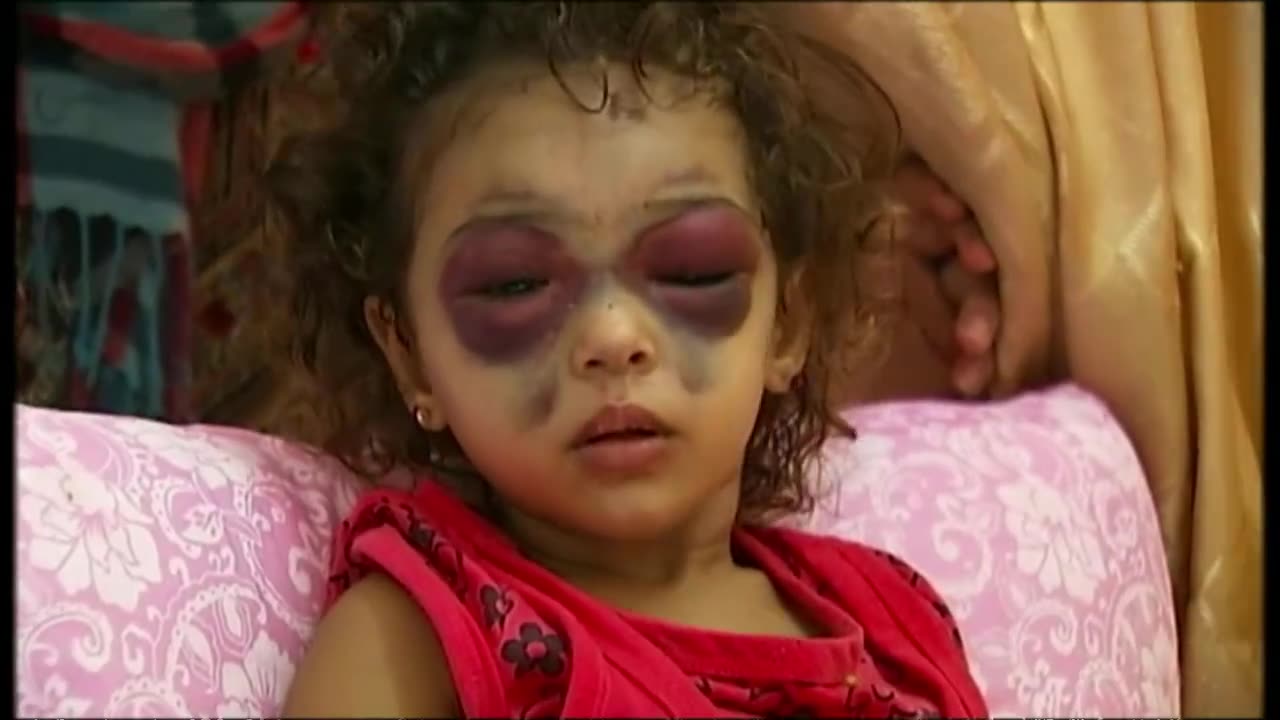 Niema la bambina con gli occhi a "Panda" ritrovata