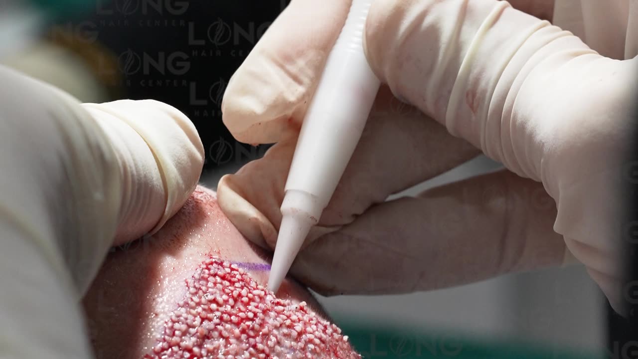 The creation of a new hairline in a natural way requires the highest level of skill and experience.