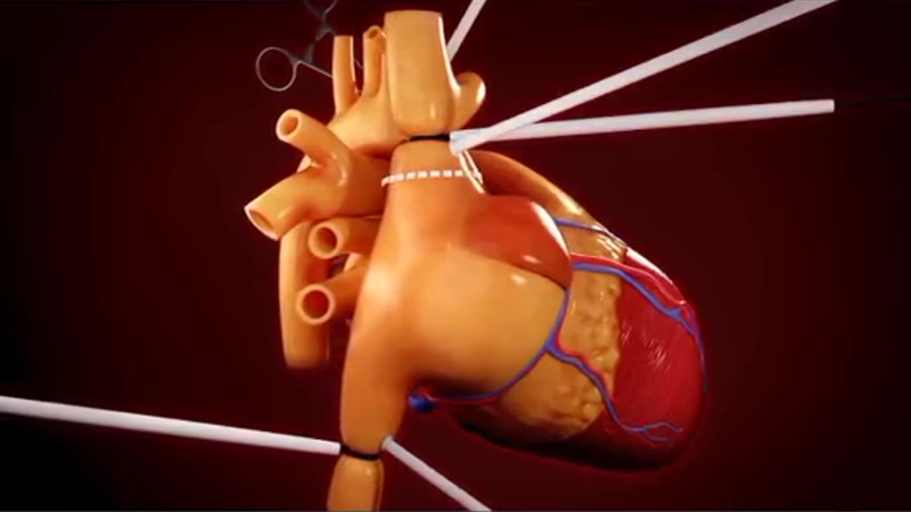 Heart Transplant Surgery (3D Animation)