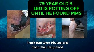 79 Year Old Man's Leg Is Crushed And Rotting Until MMS Saves His Life