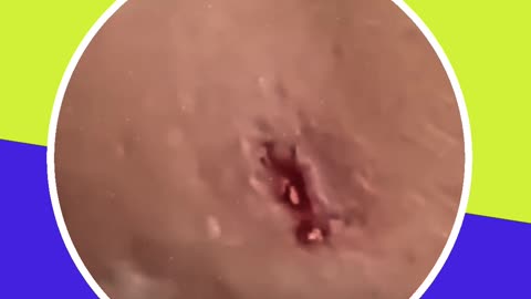 Blackhead removal new this week (ASMR) #12 #shorts