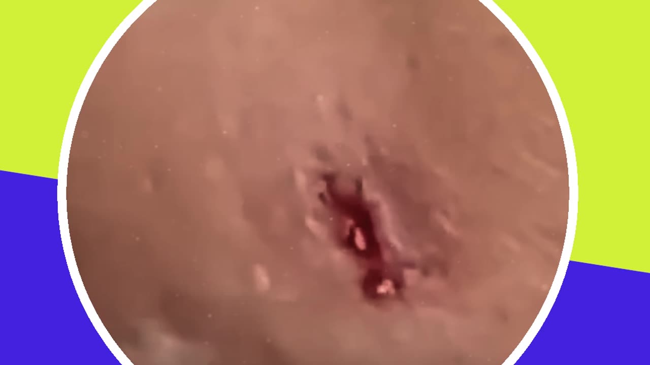 Blackhead removal new this week (ASMR) #12 #shorts