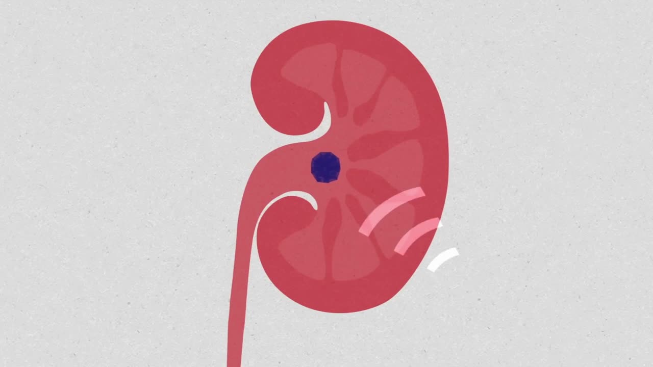 What Causes Kidney Stones?