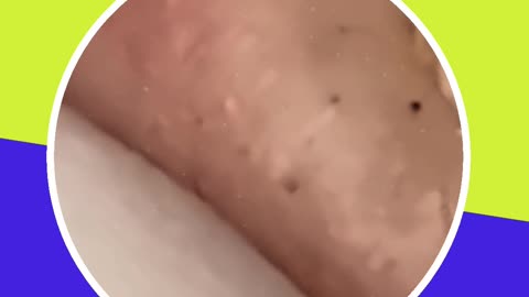 Blackhead removal new this week (ASMR) #7 #shorts