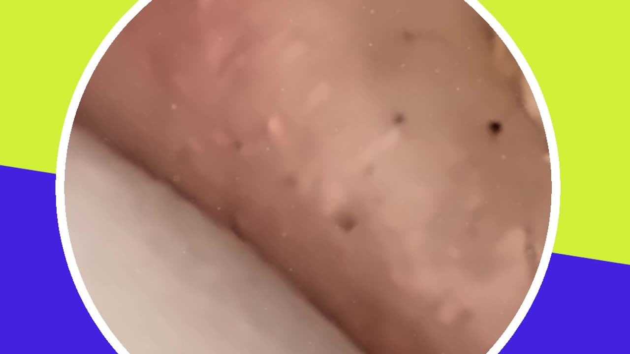 Blackhead removal new this week (ASMR) #7 #shorts
