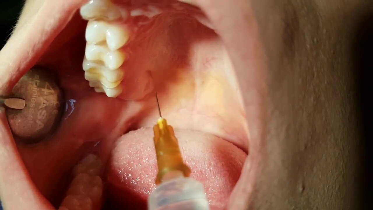 Part 47: Graphene Contamination in Anaesthetic (2025)