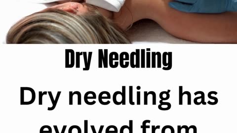 Dry Needling Therapy at Divinecare Physio Langley