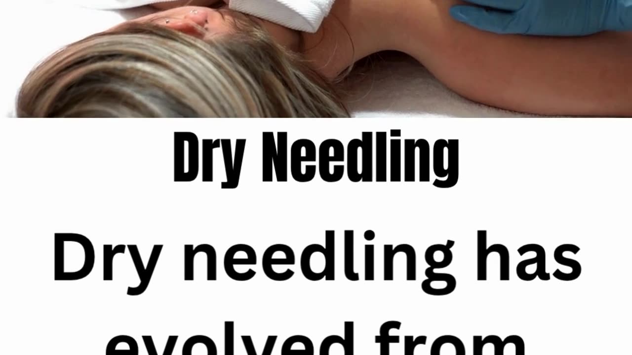 Dry Needling Therapy at Divinecare Physio Langley