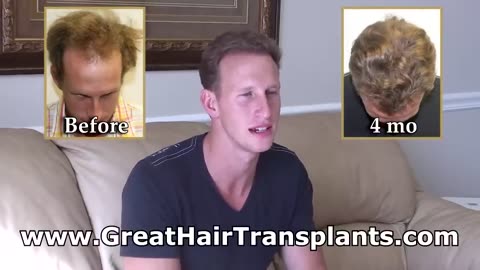 Dr. Brett Bolton Outstanding Hair Transplant Results in only 4 months