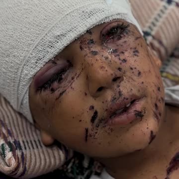 This is what Israeli missiles do to the children of Gaza every day