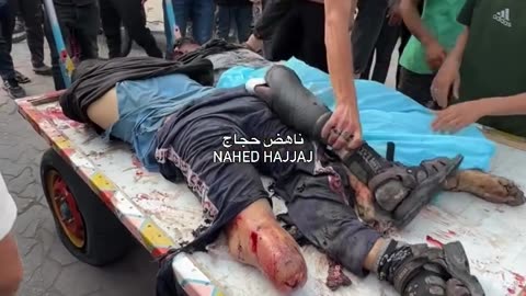 A wheelchair-bound martyr wearing a prosthetic limb was found among the martyrs (Graphic warning)