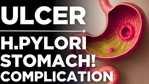 Stomach Ulcer: Symptoms, Causes (H. pylori) & Treatment | Medickpidia