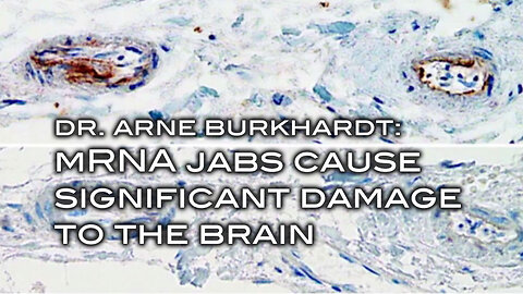 Dr. Arne Burkhardt Says mRNA Jabs Cause Significant Damage to the Brain