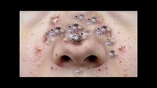 Blackheads Removal & Pimple Popper Videos for Rumble