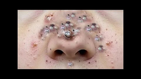 Blackheads Removal & Pimple Popper Videos for Rumble
