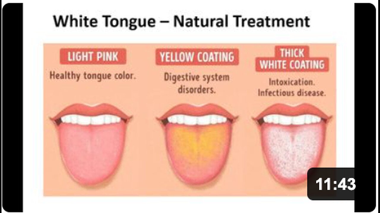 White Tongue - Natural Treatments & Causes