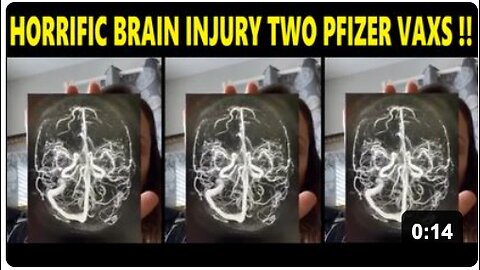 Horrific Brain Injury After Two Pfizer Vaccines !!
